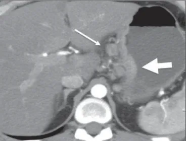 Figure 6. Gastric lymphoma. Axial CT of the abdomen, showing thickening of the wall of the lesser curvature of the stomach (broad arrow), together with regional lymph node involvement (narrow arrow).