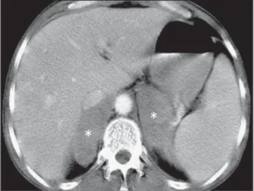 Figure 9. Intestinal perforation related to the treatment of lymphoma. Contrast- Contrast-enhanced axial CT of the abdomen, showing high-grade lymphoma of the  duode-num in a patient undergoing chemotherapy, with tumor regression followed by intestinal per