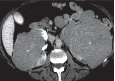 Figure 15. Contiguous renal invasion in retroperitoneal disease. Contrast-en- Contrast-en-hanced CT of the abdomen, in the axial plane (A) and in coronal reconstruction (B), showing extensive retroperitoneal lymph node involvement (arrows) and a hypovascul