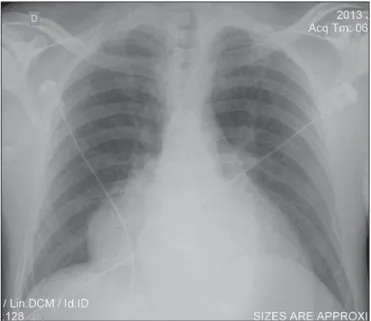 Figure 1. Chest X-ray showing a mass with well-defined borders. Pulmonary parenchyma with preserved transparency.