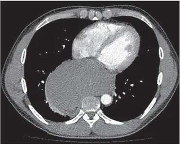 Figure 3. Axial contrast-enhanced CT of the chest showing a mass in the mid- mid-posterior mediastinum.