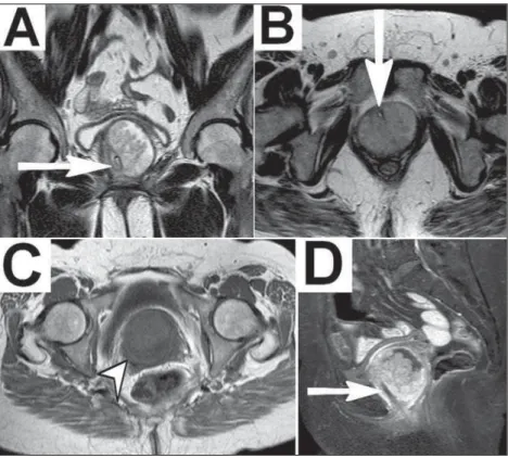 Figure 1. MRI of the pelvis. A,B: Coronal and axial T2-weighted sequences showing, respectively, cystic formation involving the urethra (showing hyperintense signal) and the UD,  mea-suring approximately 5.5 × 5.3 × 5.4 cm