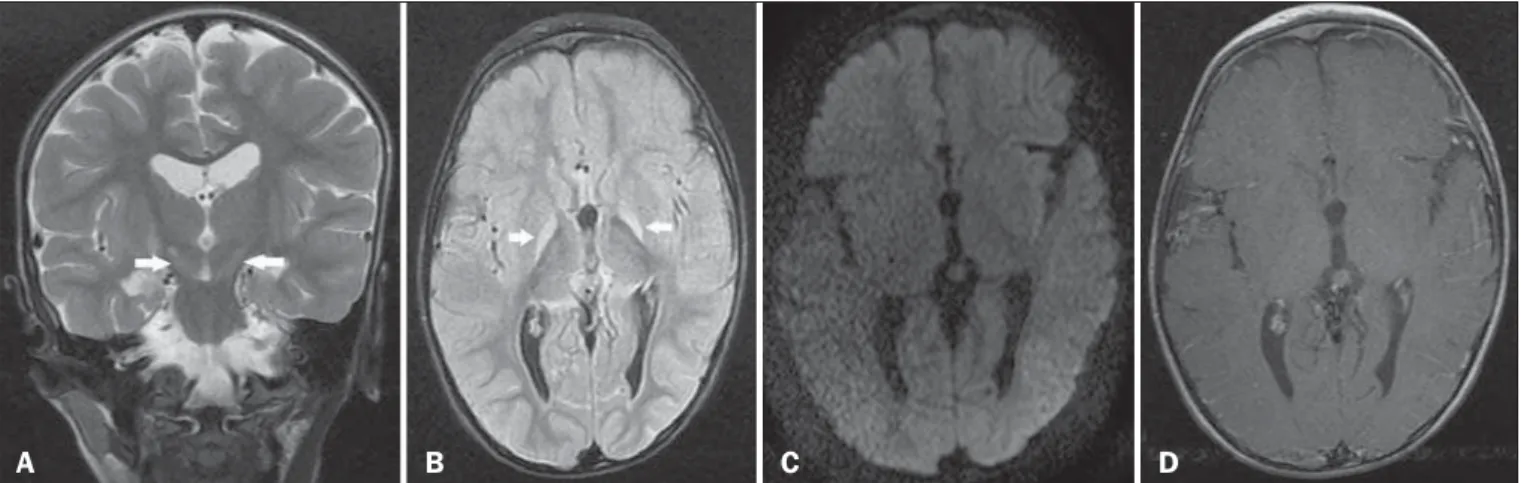 Figure 1. A: Coronal T2-weighted MRI sequence showing a bilateral, symmetrical hyperintense signal in the subthalamic nuclei (arrows), without a mass effect