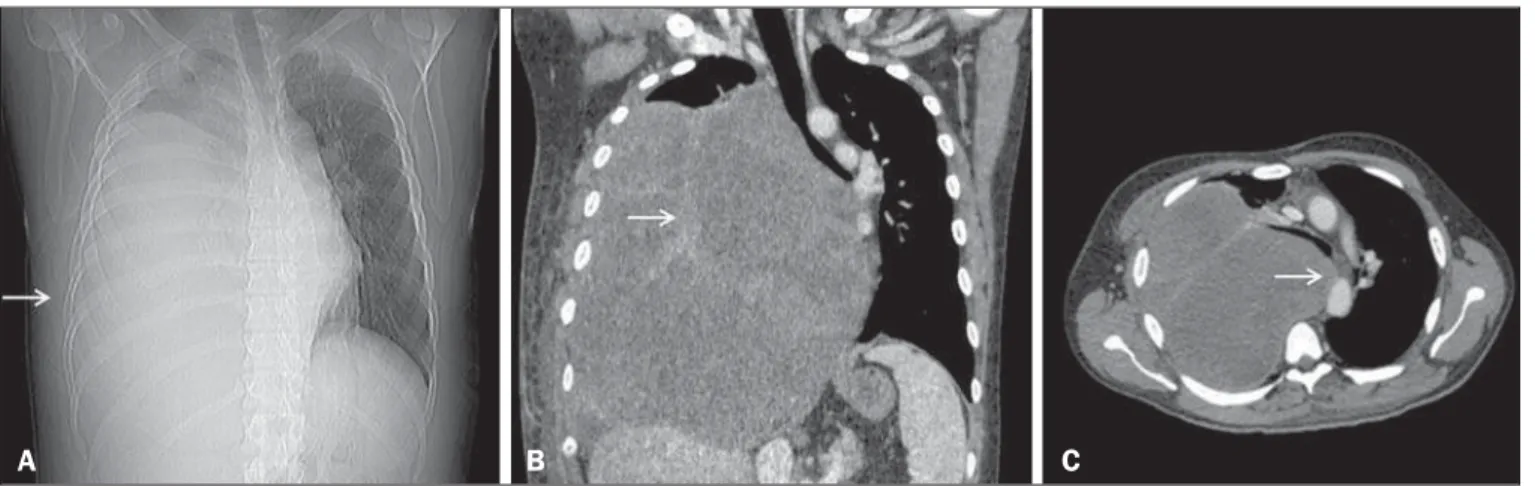 Figura 1. Imagens da TC mostram um sarcoma torácico primário no hemitórax direito. A: Scout tomográfico mostrando velamento do hemitórax direito