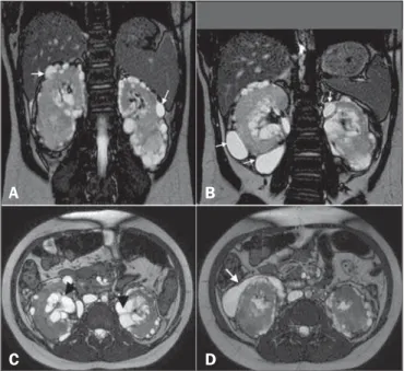 Figure 1. A: Coronal T2-weighted MRI sequence showing a loss of corticomedullary differentiation in both kidneys and multiple cystic lesions, with thin walls, located in the cortex (arrows)