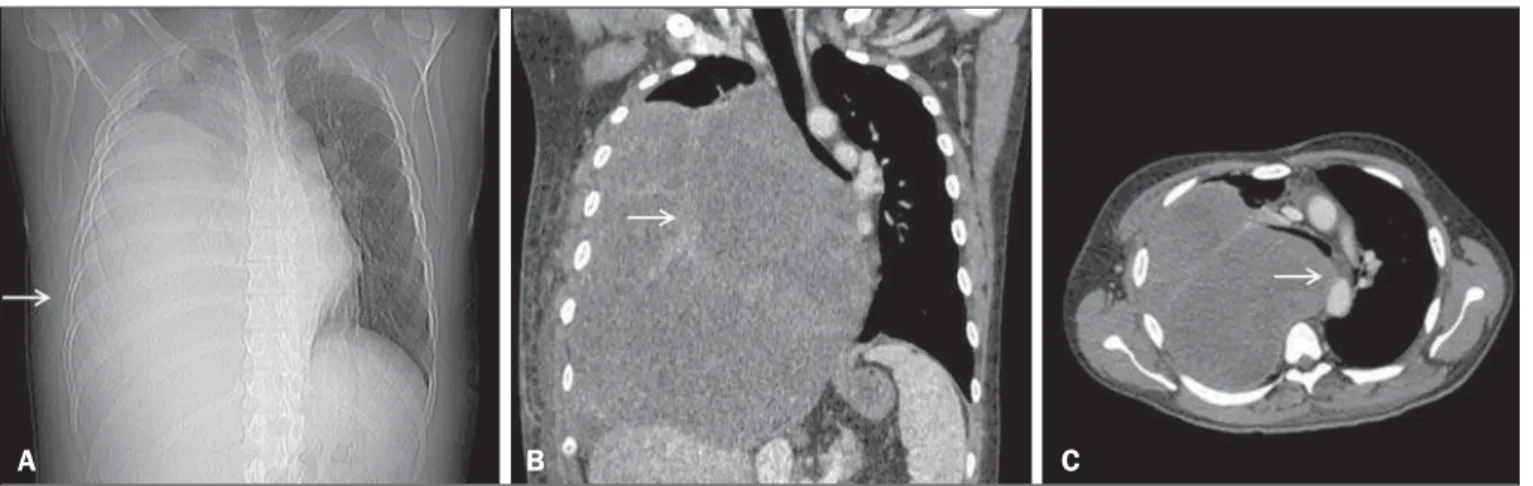 Figure 1. CT scan showing a primary sarcoma in the right hemithorax. A: CT scout image showing opacification of the right hemithorax