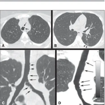 Figure 1. A: Axial CT slice showing irregular narrowing of the tracheal lumen (arrows)