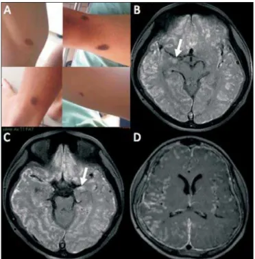 Figure 1. A: Multiple cutaneous nevi seen on physical examination. B,C: Gado- Gado-linium-enhanced axial T1-weighted MRI sequence with fat suppression showing hyperintense signals along the cortical sulci of the cerebral hemispheres,  pre-sumably due to di