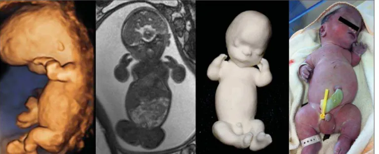 Figure 2. Case 18. Fetus with trisomy 21. Whole-body virtual and physical model obtained by MRI.