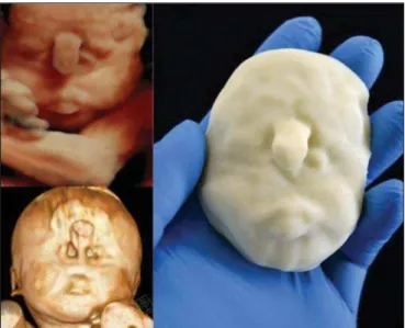 Figure 4D. Polydactyly of the foot identified by 3D-US, by MRI, and in the physical model.