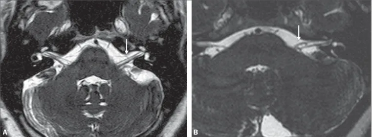 Figure 1. Chavda grade I vascular loops in the AICA. Note that the vessel runs alongside the internal auditory meatus of the left ear, without extending to the inside (arrows).