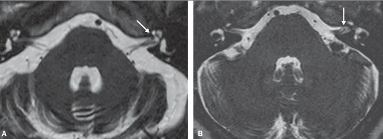 Figure 3. Examples of Chavda grade III vascular loops in the AICA. The vessel occupies more than 50% of the canal of the internal auditory meatus, reaching its basal portion (arrows).