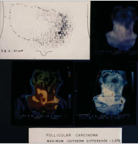 Figure 1. Scintigraphy and ther- ther-mography of a thyroid nodule  (folli-cular carcinoma).