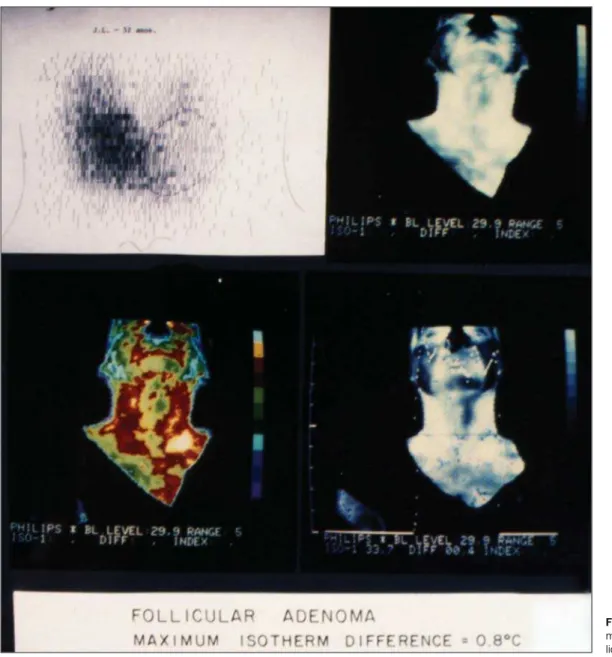 Figure 2. Scintigraphy and ther- ther-mography of a thyroid nodule  (fol-licular adenoma).