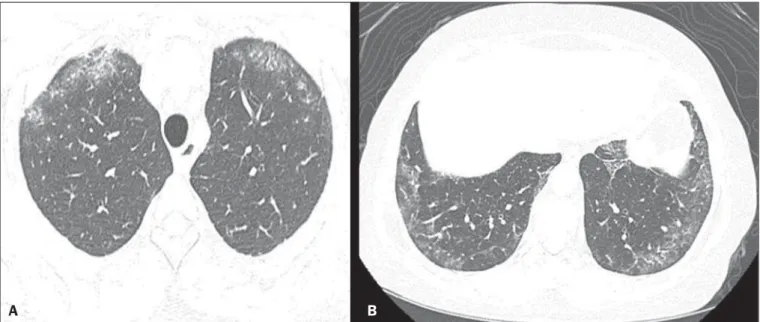Figure 1. A 55-year-old female with an 8-year history of SSc, without respiratory symptoms
