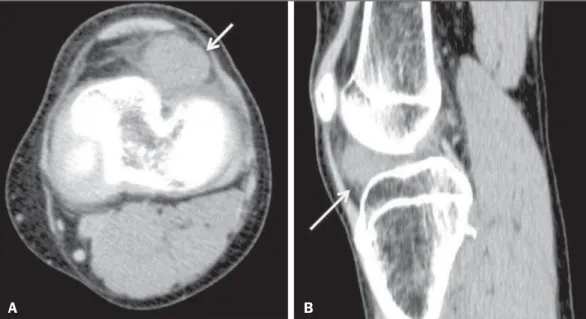Figure 2. Intracapsular chondroma. CT scans acquired in the axial (A) and sagittal (B) planes