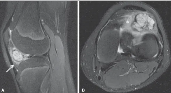 Figure 3. Intracapsular chondroma. PD-weighted, fat-suppressed MRI scans of the same patient depicted in Figure 2, acquired in the axial (A) and sagittal (B) planes.