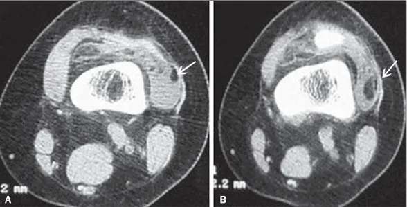 Figure 5. Lipoma arborescens. CT scans, both acquired in the axial plane. The anomalous tissue cited in Figure 4 shows hypoattenuation, indicating its adipose nature (arrows)
