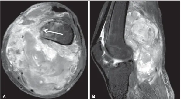 Figure 7. Synovial sarcoma. Fat-suppressed T1-weighted MRI sequences in the axial (A) and sagittal (B) planes, after intravenous injection of paramagnetic contrast.