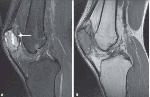 Figure 8. Aneurysmal bone cyst of the patella. PD-weighted MRI sequences, both in the sagittal plane, with fat suppression (A) and without (B), showing heteroge- heteroge-neous multiloculated expansile lesion involving the patella