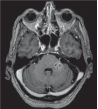 Figure 1. Listeria. Axial FLAIR MRI sequence showing irregular, ill-defined hyperintense lesions.