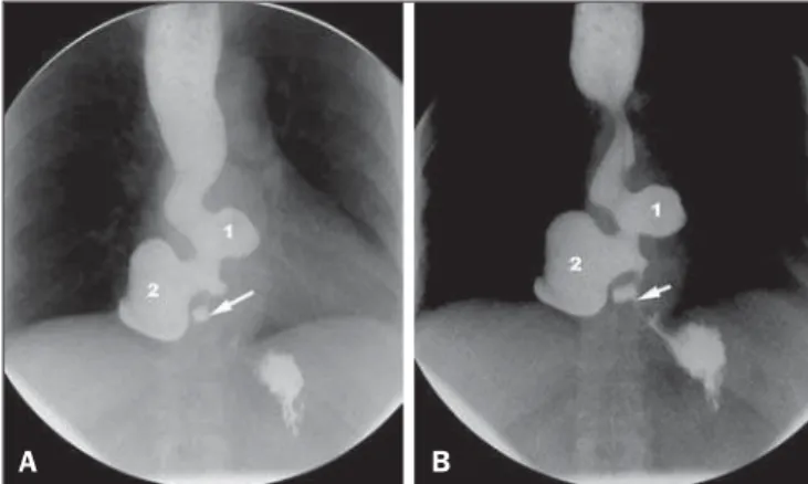 Figura 1. Sequências de imagens da esofagografia em ortostase mostrando redução da luz e espasmo do esôfago distal, caracterizando acalasia (setas).