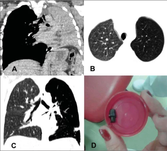 Figura 1. Em A, TC de tórax mostra atelectasia total do pulmão esquerdo.