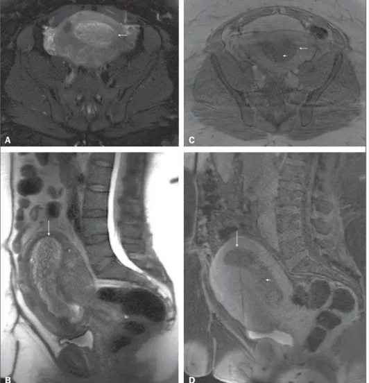 Figure 1. Pelvic MRI. Axial fat-suppressed (A) and sagittal (B) T2-weighted images, and  post-contrast axial (C) and sagittal fat-suppressed (D) T1-weighted MRI images