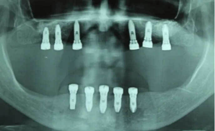 Figura 1A. Radiografia panorâmica mostrando os implantes instalados.