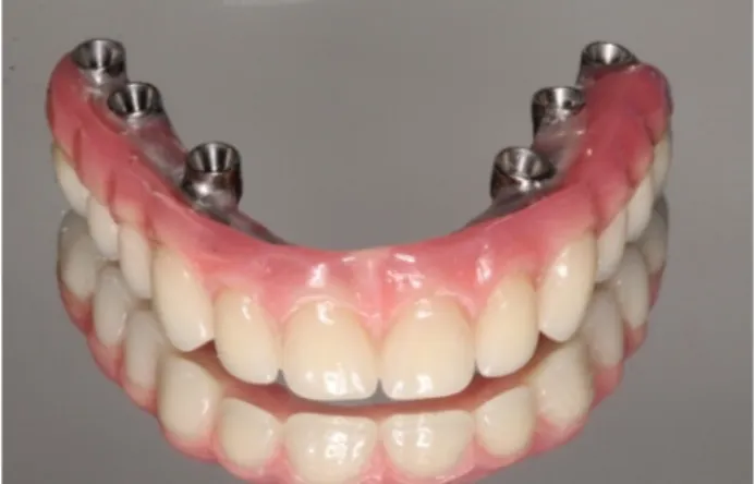 Figura 7 D. Sorriso da paciente após instalação das próteses definitivas.