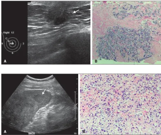 Figura 2. A: Ultrassonografia mostrando múltiplos nódulos esplênicos  hipoecogêni-cos, um deles apontado pela seta