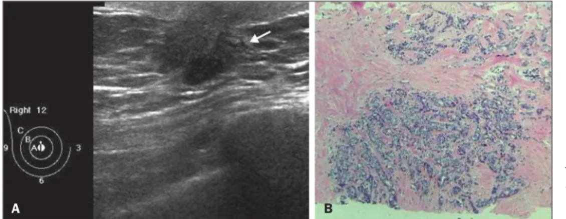 Figure 1. A: Ultrasound showing a solid, hypoechoic, irregular spiculated nodule,  ad-jacent to the papilla of the right breast