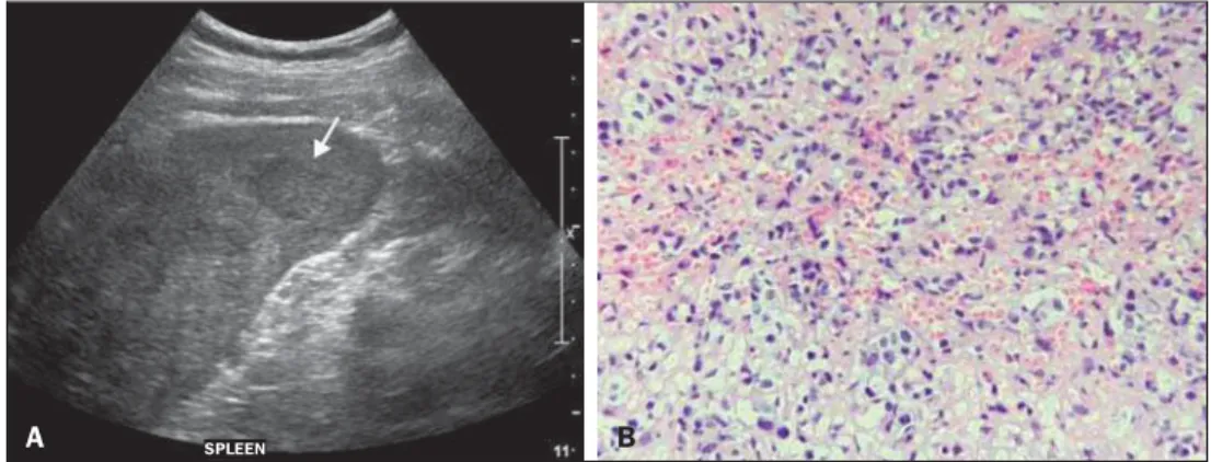 Figure 2. A: Ultrasound showing multiple, hypoechoic splenic nodules, one of which is indicated by the arrow
