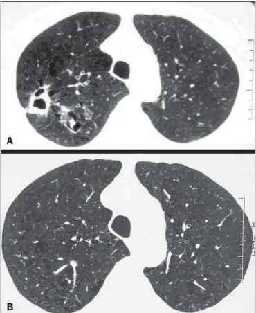 Figure 3. Areas showing a mosaic pattern of attenuation and tree-in-bud opaci- opaci-ties.
