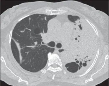 Figure 5. Consolidation and cavity in the left lung.