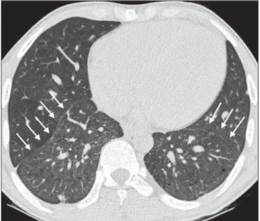 Figure 5. Axial chest CT scan showing increased caliber of the peripheral pulmo- pulmo-nary vessels (arrows).