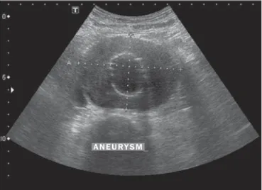 Figure 4. Bar chart showing an- an-eurysm sac diameters determined