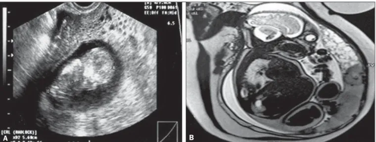 Figure 2. A: Routine transvaginal ultrasound at 12 weeks of pregnancy, showing a fetus with normal morphology and a placental area suggestive of complete hydatidiform mole