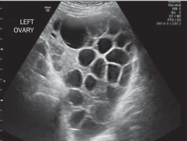 Figure 4. Pelvic ultrasound showing a massive theca lutein cyst in a patient with complete hydatidiform mole.