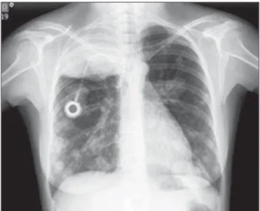 Figure 7. Posteroanterior chest X-ray, acquired during follow-up, showing numer- numer-ous, dense, bilateral metastatic nodules, of varying sizes.