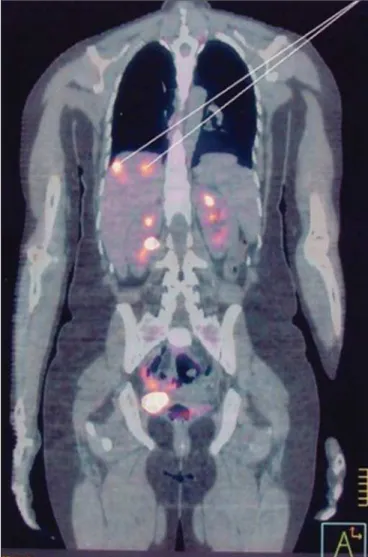 Figure 9. CT of the abdomen showing three hypointense, hypovascular lesions with peripheral enhancement in a patient with GTN