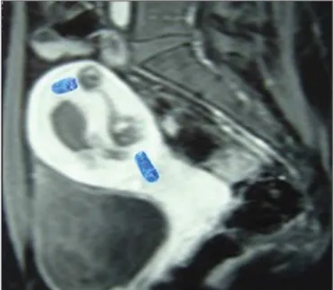 Figure 11. Gadolinium contrast-enhanced MRI scan of the pelvis, showing, hypointense lesions with avid uptake and vascular dilation in the myometrium, sometimes in close contact with the uterine effusion, in patients treated for GTN.