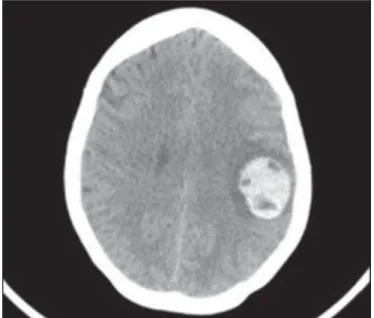 Figure 12. MRI scan of the brain, showing a mass suggestive of metastatic choriocarcinoma, in a 32 yeold patient presenting with headache, speech  ar-ticulation disorder, and dysphagia.