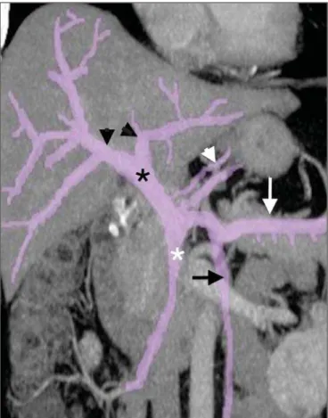 Figure 1. Reformatted coronal computed tomography scan showing the anatomy of the portal venous system