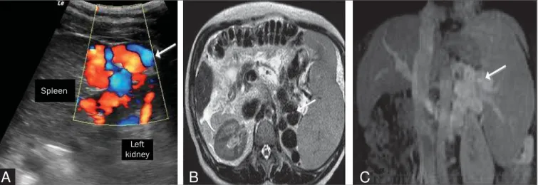 Figure 6. Splenorenal shunt in a patient with hepatitis C (arrow).