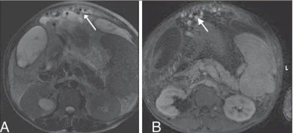 Figure 10. T2-weighted magnetic reso- reso-nance imaging (A) and  contrast-en-hanced, T1-weighted magnetic  reso-nance imaging (B), showing dilated, tortuous mesenteric varices (arrows), with probable drainage to the gonadal vein, renal vein, or inferior v