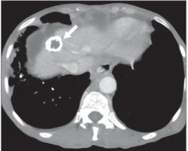 Figure 1. Blue rubber bleb nevus syndrome. Axial CT scan showing a calcified hepatic nodule (arrow), suggestive of hemangioma.
