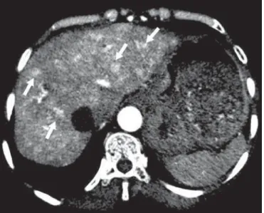 Figure 6. Rendu-Osler-Weber syndrome. Axial maximum intensity projection CT reconstructions