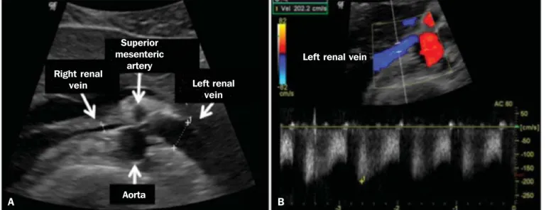Figure 8. Nutcracker syndrome. A: Axial CT identifying stenosis in the left renal artery, between the superior mesenteric artery and the aorta (arrow), with pre-stenotic ectasia