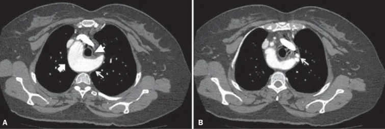 Figure 3. A: Chest computed tomography angiography, maximum intensity projection reconstruction, in the coronal plane, showing right aortic arch (thin white arrow) and Kommerell’s diverticulum (white arrowhead), giving rise to the left common carotid arter